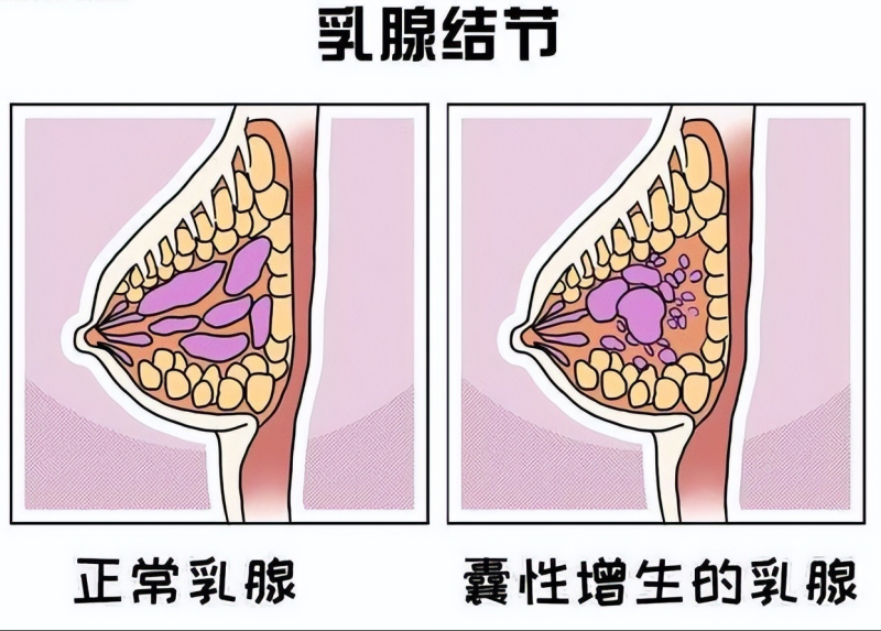 老中医散结秘方——消瘤汤，可消一切血瘀型囊肿、结节(图6)
